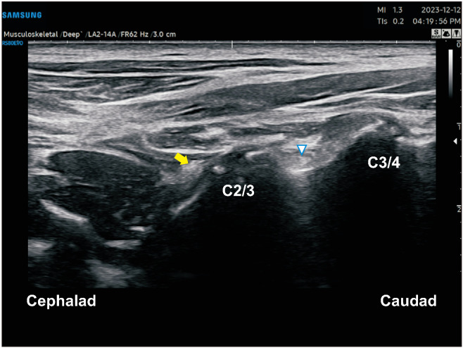 The pros and cons of ultrasound-guided procedures in pain medicine.