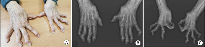 Jaccoud's arthropathy in osteogenesis imperfecta.