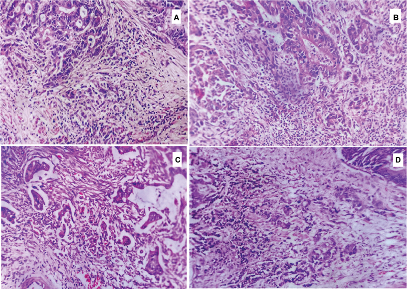 Evaluation of Applicability of Tumor Budding and Poorly Differentiated Clusters as Additional Prognostic Markers in Colorectal Cancers.