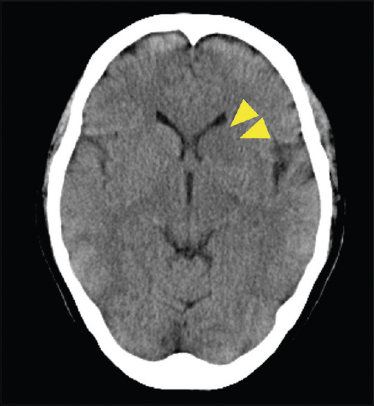 Lemierre's Syndrome Complicated by Venous Stroke due to a Massive Cerebral Venous Thrombus.