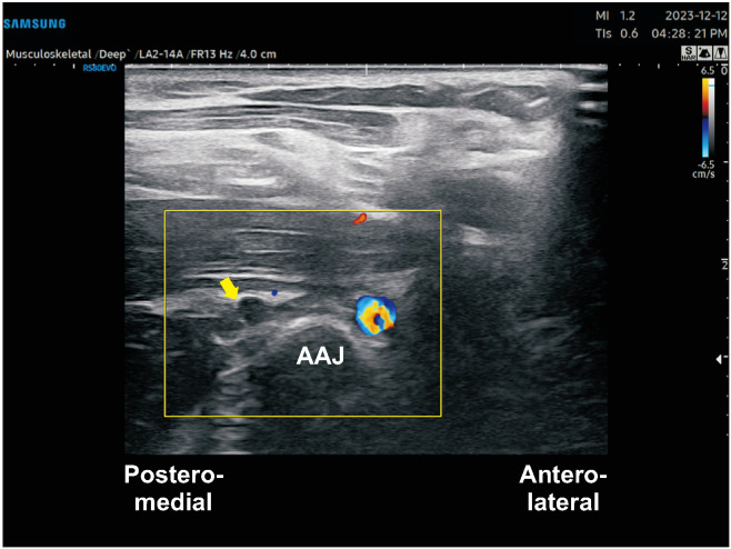 The pros and cons of ultrasound-guided procedures in pain medicine.