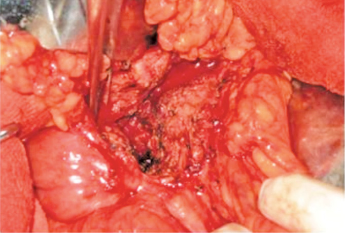 Comprehensive Outcomes of the Frey Procedure: A Single-center Perspective.