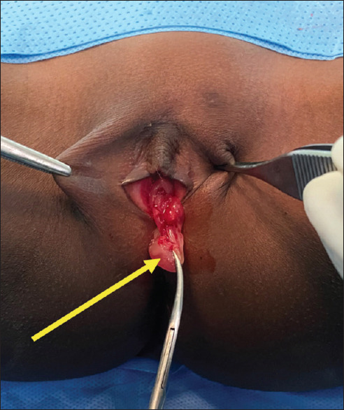 Intravaginal Foreign Body: A Rare Cause of Persistent Vaginal Discharge in a Child.