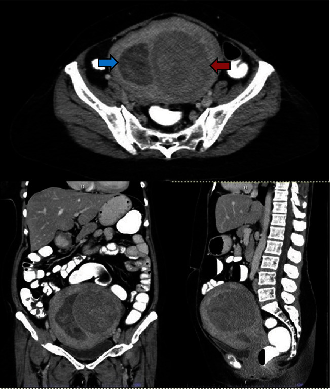 Fifteen-Centimeter Giant Tamoxifen-Associated Endometrial Polyp Presenting With Constipation: A Case Report and Review of the Literature.