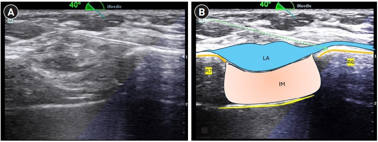 Comparison of analgesic efficacy of combined external oblique intercostal and rectus sheath block with local infiltration analgesia at port site in patients undergoing laparoscopic cholecystectomy: a randomized controlled trial.