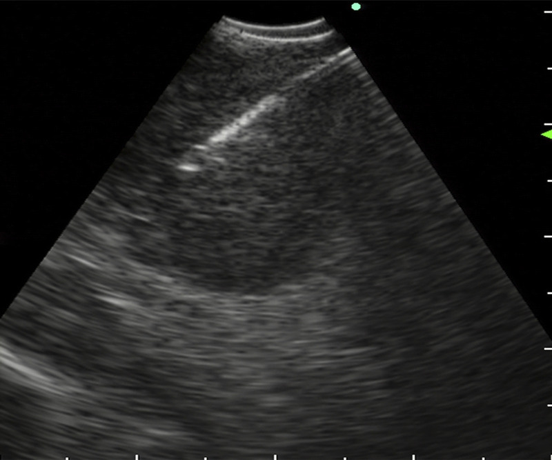 EUS-FNA to diagnose a submucosal oropharyngeal carcinoma.