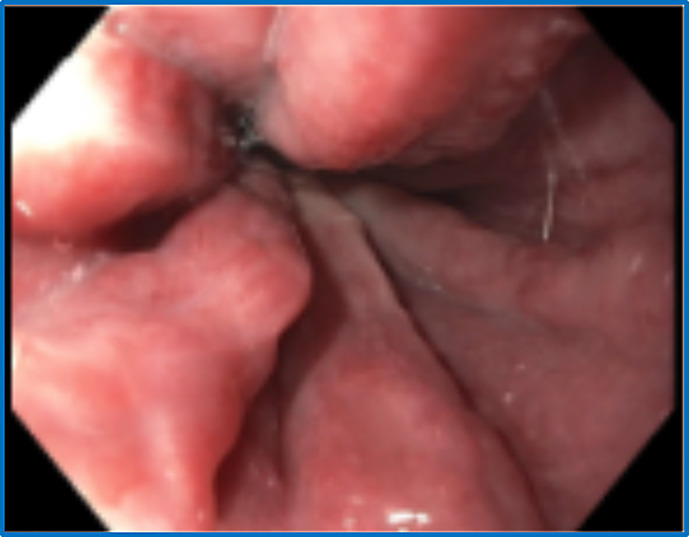 Non-Cirrhotic Portal Hypertension in Turner's Syndrome: A Case Report.