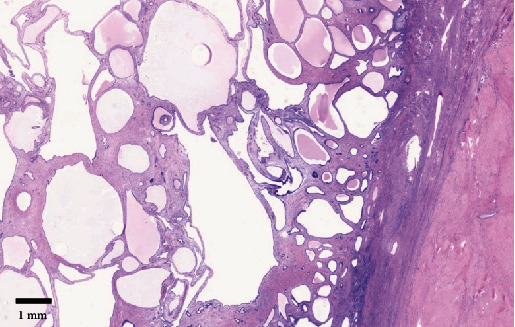 Fifteen-Centimeter Giant Tamoxifen-Associated Endometrial Polyp Presenting With Constipation: A Case Report and Review of the Literature.