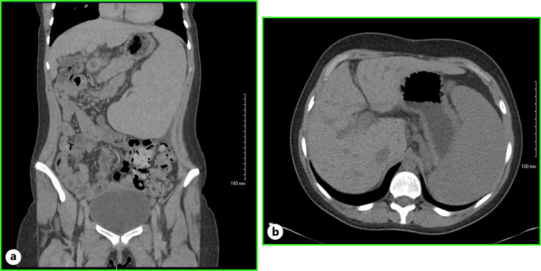 Non-Cirrhotic Portal Hypertension in Turner's Syndrome: A Case Report.