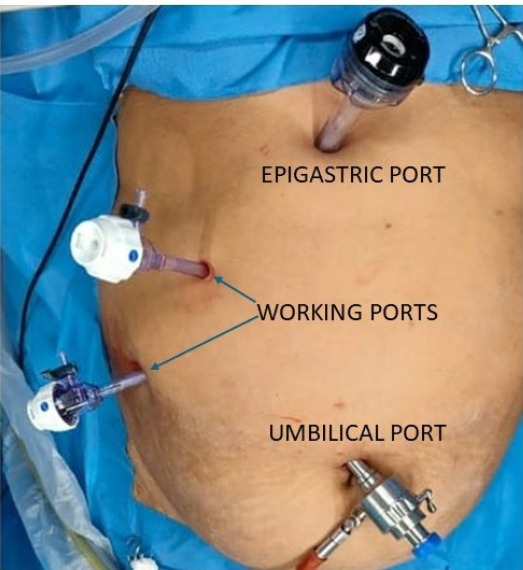Comparison of analgesic efficacy of combined external oblique intercostal and rectus sheath block with local infiltration analgesia at port site in patients undergoing laparoscopic cholecystectomy: a randomized controlled trial.