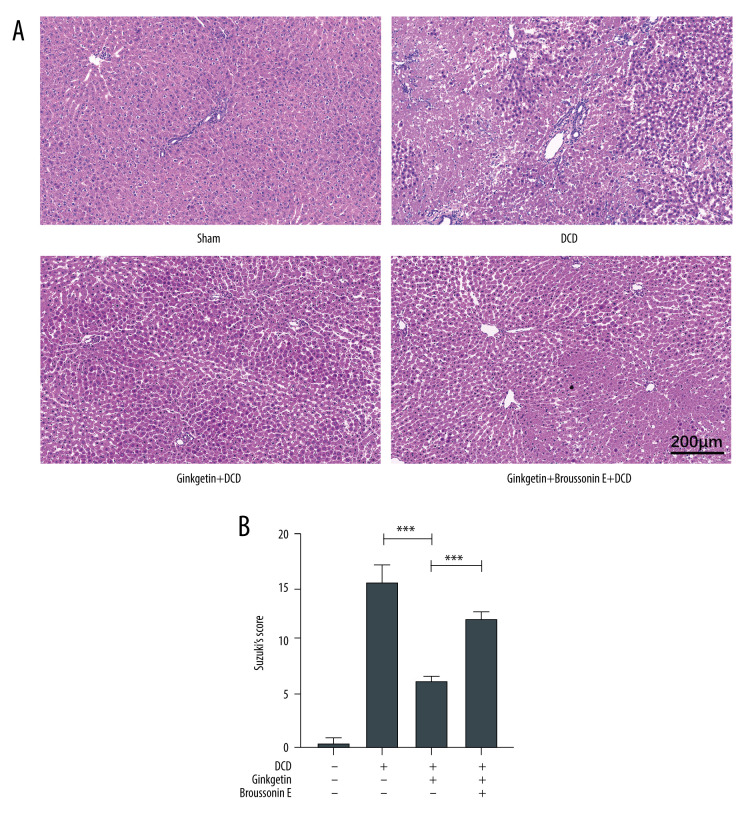 Ginkgetin Pretreatment Reduces Inflammatory Response in DCD Donor Liver via JAK2/STAT3 Signaling Pathway.