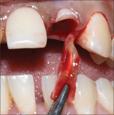 Comparative evaluation of implant stability and esthetics by partial extraction therapy and immediate implant placement in maxillary anterior region: A clinical study.
