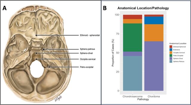 Surgical management of skull base chordomas and chondrosarcomas: insights from a national cohort study.