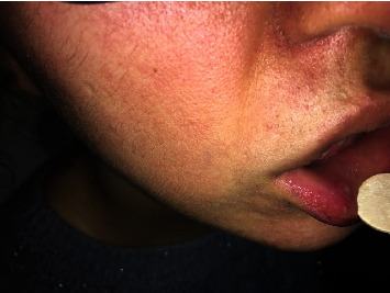 Adult-Onset Periodic Fever, Aphthous Stomatitis, Pharyngitis, and Cervical Adenitis Syndrome on the Basis of Selective IgA Deficiency.