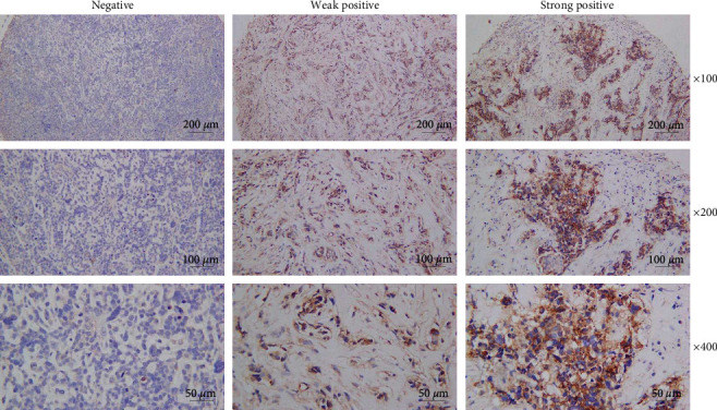PD-L2 Expression in Breast Cancer Promotes Tumor Development and Progression.