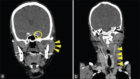 Lemierre's Syndrome Complicated by Venous Stroke due to a Massive Cerebral Venous Thrombus.
