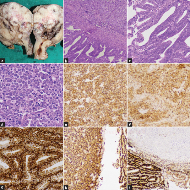 Mixed Large Cell Neuroendocrine Carcinoma and Endometrioid Adenocarcinoma: A Rare Case Report with Review of Literature.