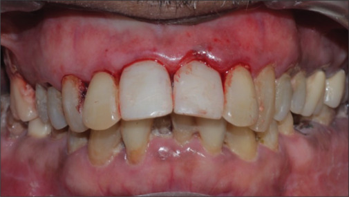 Comparative evaluation of implant stability and esthetics by partial extraction therapy and immediate implant placement in maxillary anterior region: A clinical study.