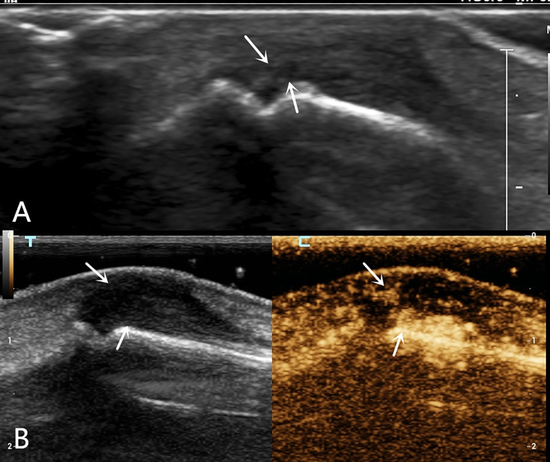 Applicability of combined high-frequency and contrast-enhanced ultrasound in finger extensor tendon injuries: three case reports.
