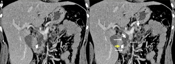 Comprehensive Outcomes of the Frey Procedure: A Single-center Perspective.