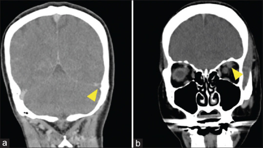 Lemierre's Syndrome Complicated by Venous Stroke due to a Massive Cerebral Venous Thrombus.