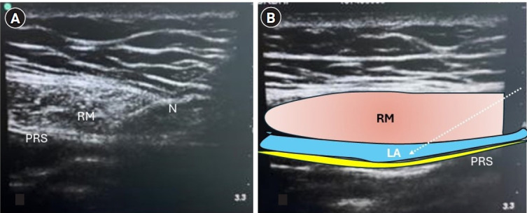 Comparison of analgesic efficacy of combined external oblique intercostal and rectus sheath block with local infiltration analgesia at port site in patients undergoing laparoscopic cholecystectomy: a randomized controlled trial.
