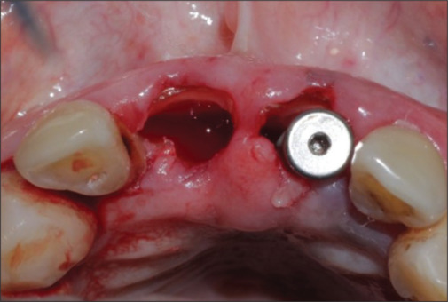 Comparative evaluation of implant stability and esthetics by partial extraction therapy and immediate implant placement in maxillary anterior region: A clinical study.