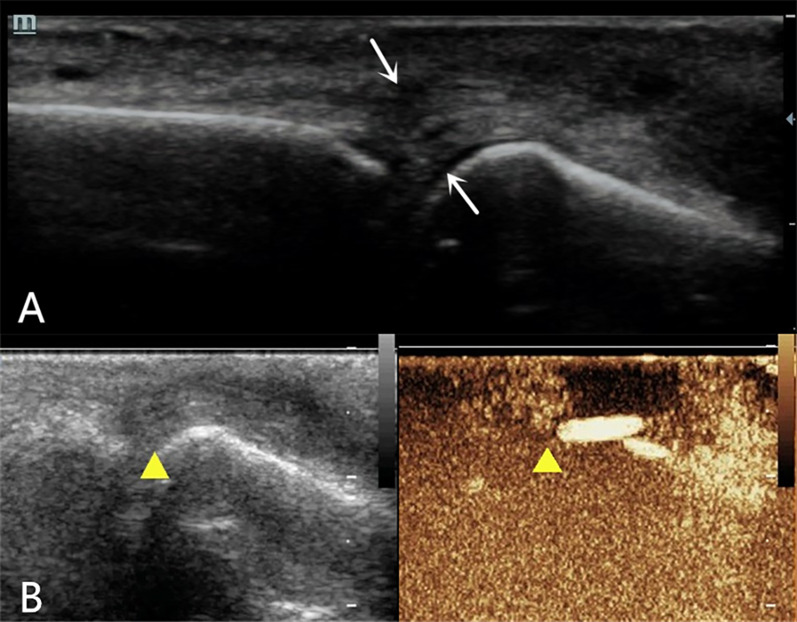 Applicability of combined high-frequency and contrast-enhanced ultrasound in finger extensor tendon injuries: three case reports.