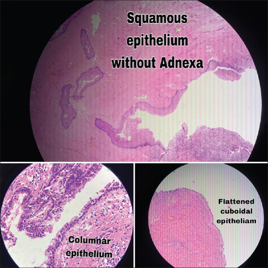 Tailgut Cyst in a Child: A Case Report and Review of Literature.