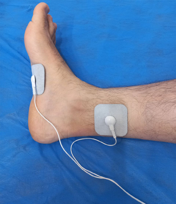 Efficacy of Percutaneous vs Transcutaneous Posterior Tibial Nerve Stimulation in Overactive Bladder Syndrome: A Randomized Clinical Trial.
