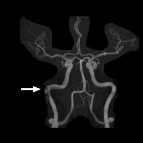 Spontaneous Right Intrapetrous Internal Carotid Dissection in a Patient With Active COVID-19.
