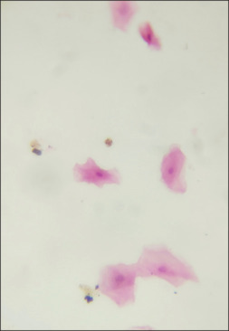 Comparative study of conventional exfoliative cytology and centrifuged liquid-based cytology in oral leukoplakia and oral squamous cell carcinoma patients.