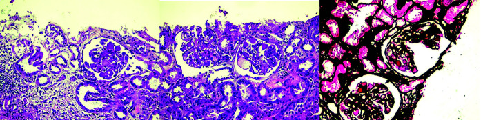 Complete Response with Immunotherapy Alone after Discontinuing VEGF Inhibitor in Advanced Hepatocellular Carcinoma: A Case Report.