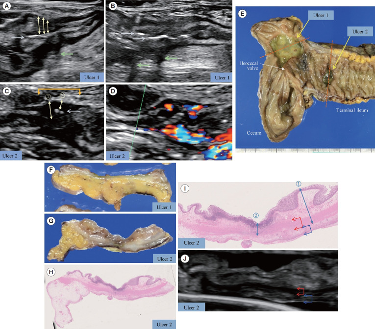 Intestinal ultrasound for intestinal Behçet disease reflects endoscopic activity and histopathological findings.
