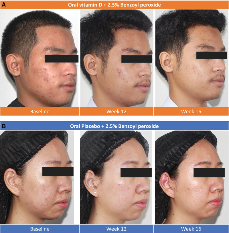 Role of vitamin D supplement adjunct to topical benzoyl peroxide in acne: a randomized double-blinded controlled study.