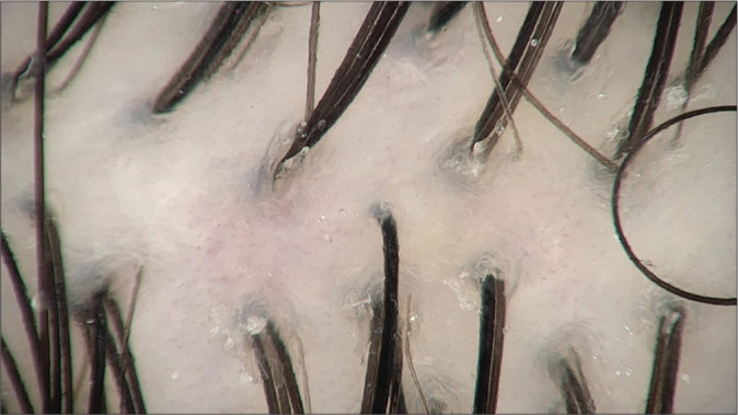 Quantitative trichoscopic analysis of hair density in people attending tertiary care hospital - A cross-sectional study.