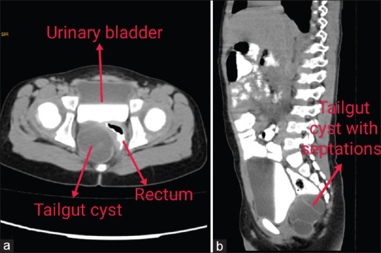 Tailgut Cyst in a Child: A Case Report and Review of Literature.