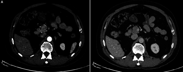 Complete Response with Immunotherapy Alone after Discontinuing VEGF Inhibitor in Advanced Hepatocellular Carcinoma: A Case Report.