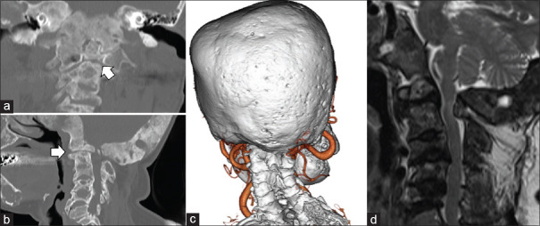 Navigation-assisted occipitocervical fixation and decompression in a patient with polyostotic fibrous dysplasia.