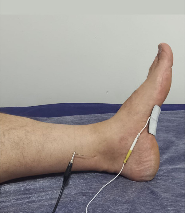 Efficacy of Percutaneous vs Transcutaneous Posterior Tibial Nerve Stimulation in Overactive Bladder Syndrome: A Randomized Clinical Trial.