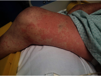 Life-Threatening Anaphylaxis due to Cerebrolysin®.