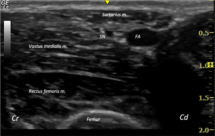 Ultrasound-guided perineural injection of the saphenous nerve in goat cadavers.