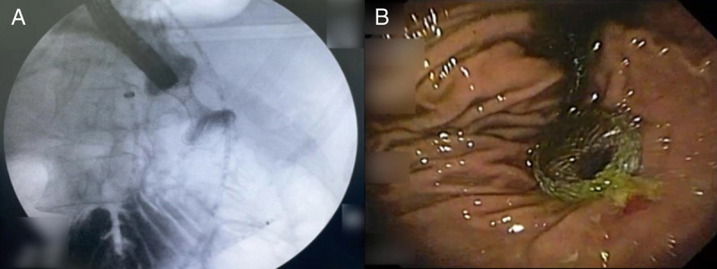 Double EUS-guided bypass for gastric outlet and biliary tract malignant obstruction: A standardized one-step approach (with videos).