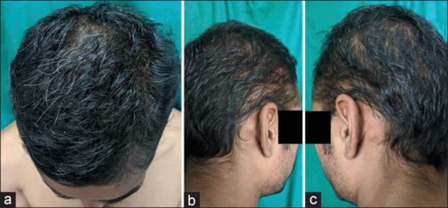Moth-eaten alopecia and beyond: Syphilitic alopecia - Revisited.
