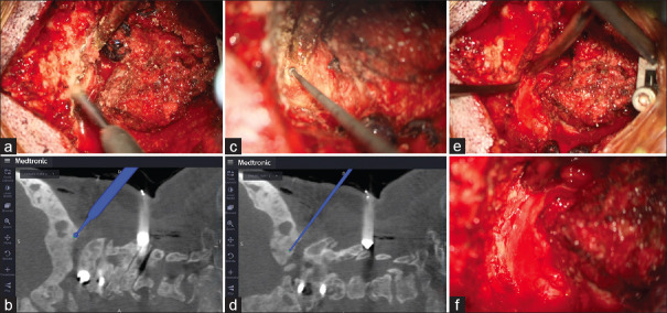 Navigation-assisted occipitocervical fixation and decompression in a patient with polyostotic fibrous dysplasia.