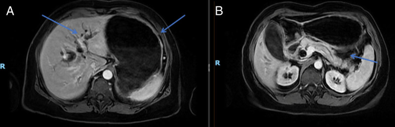 Double EUS-guided bypass for gastric outlet and biliary tract malignant obstruction: A standardized one-step approach (with videos).