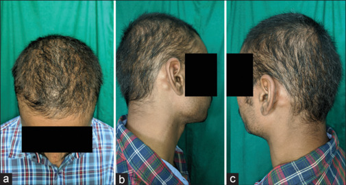 Moth-eaten alopecia and beyond: Syphilitic alopecia - Revisited.