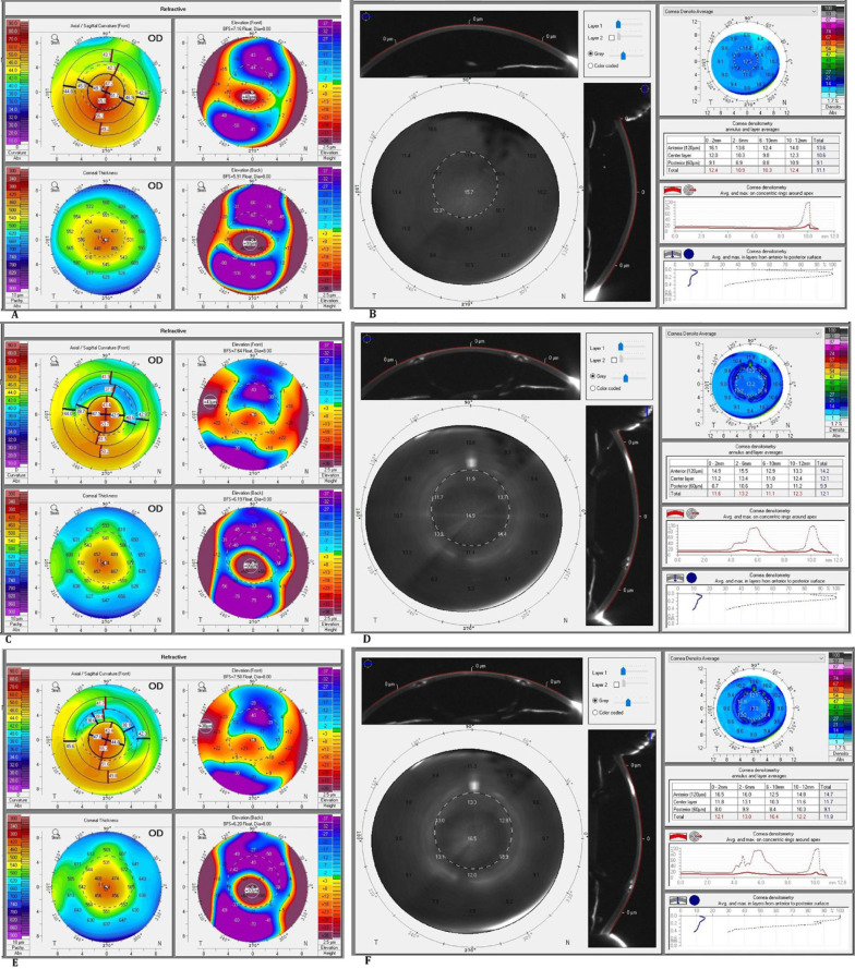 Corneal densitometry changes after femtosecond laser-assisted intracorneal ring segments implantation in keratoconus.