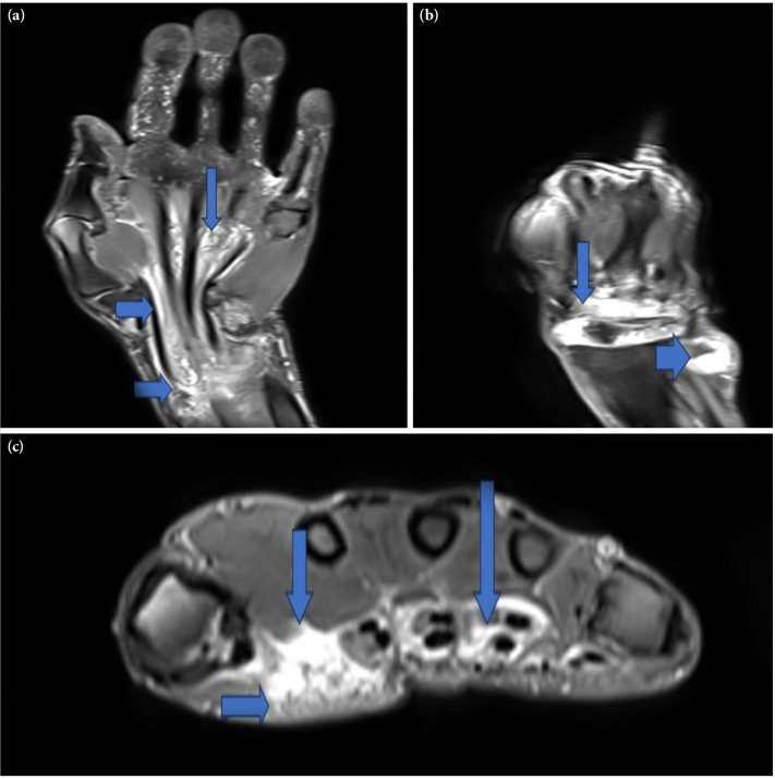 Tuberculosis tenosynovitis: A rare cause of tenosynovitis in the hand and wrist.