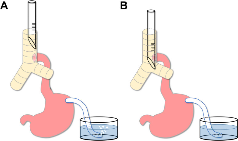 Enhanced estimation strategy for determining the location of tracheoesophageal fistula in a preterm, low-birth-weight infant with congenital esophageal atresia type C and duodenal atresia: a case report.